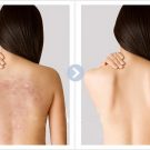 Cách trị mụn ở lưng hiệu quả nhất