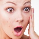 Giải đáp lý do vì sao khó trị dứt điểm được mụn