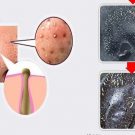 Có nên dùng mặt nạ lột mụn không?