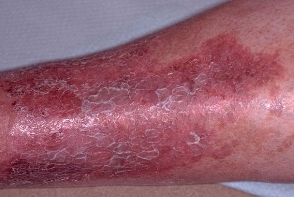 Hỏi đáp: Bệnh eczema có chữa khỏi được không?