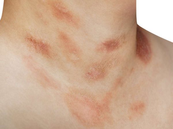 Da nổi mẩn đỏ ngứa là dấu hiệu của các loại bệnh về da nào?