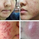 Dấu hiệu nhận biết da nhiễm corticoid và cách chữa trị