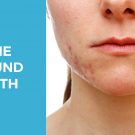 Mẹo hay chỉ cách trị mụn bọc ở cằm