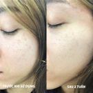 NGUYÊN NHÂN ĐIỀU TRỊ NÁM DAI DẲNG CỦA CHỊ EM MÃI KHÔNG CẢI THIỆN
