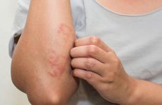 Người bị dị ứng nên kiêng ăn gì?