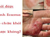 Hỏi đáp: Bệnh eczema có chữa khỏi được không?
