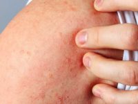 Da nổi mẩn đỏ ngứa là dấu hiệu của các loại bệnh về da nào?