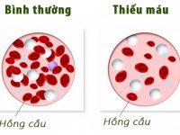 Tại sao đôi bàn tay bạn luôn bị lạnh?