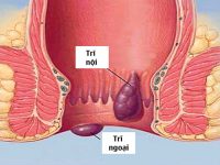 Điều trị thiếu máu hiệu quả do bệnh trĩ bằng y học cổ truyền