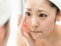 Vừa nặn mụn xong nên làm gì để da được hồi phục tốt nhất?