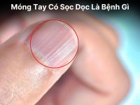 Móng Tay Có Sọc Dọc Là Bệnh Gì